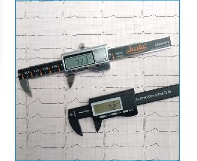 Ein Anwendungsbeispiel eines elektronischen EKG-Lineals.